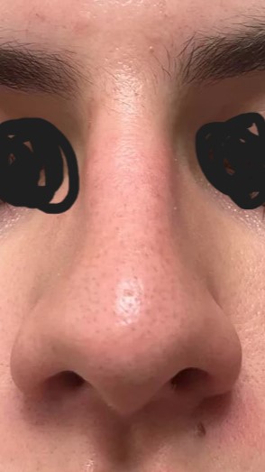 Hi, could you please check the condition of the pores on my nose?